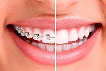 تقويم الاسنان